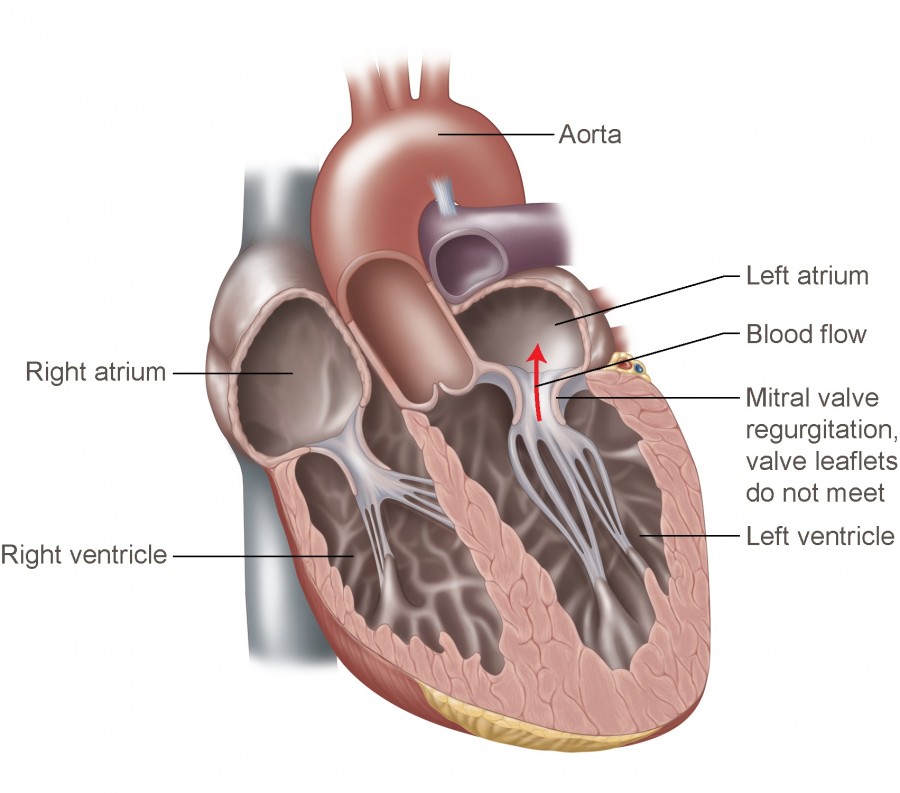 Mitral Valve Regurgitation Temple Health